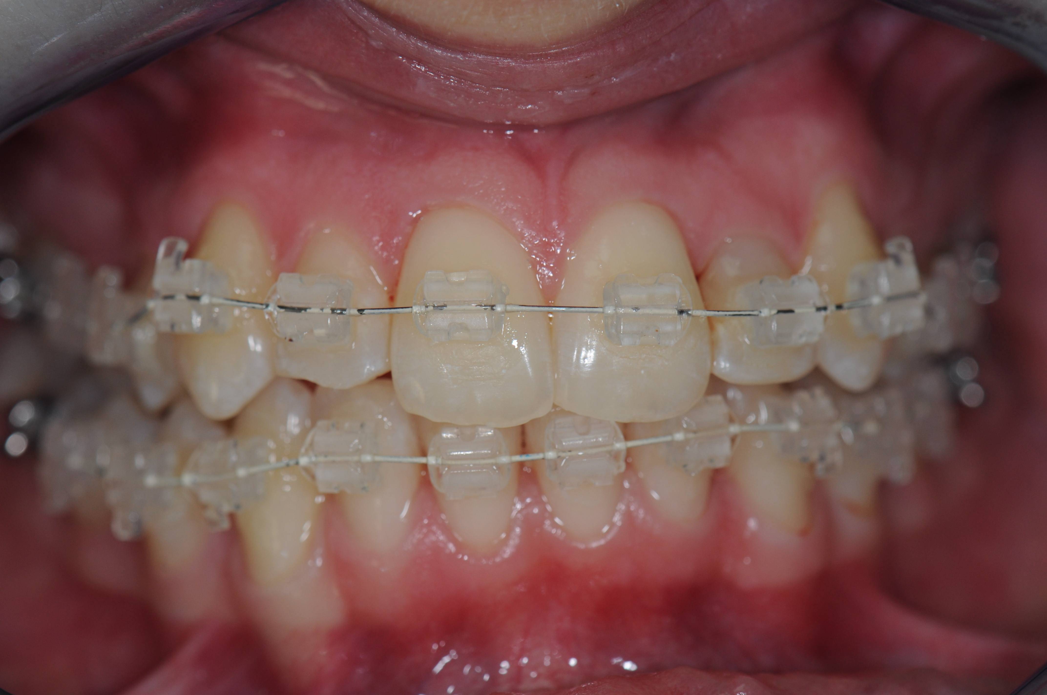 LiteWire forarbejdning – TandCity