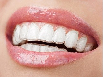 Invisalign i København – TandCity